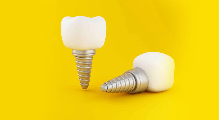 dental-implants