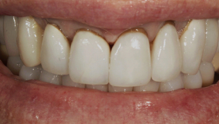 Before-Porcelain Crowns