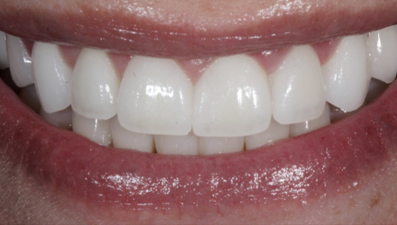 After-Implants and Crowns