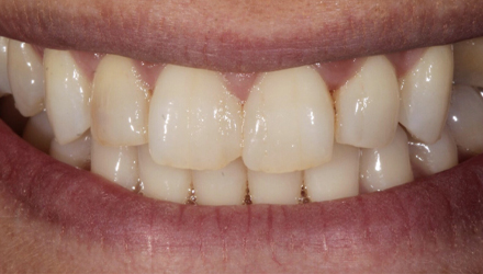 Before-Implants and Crowns