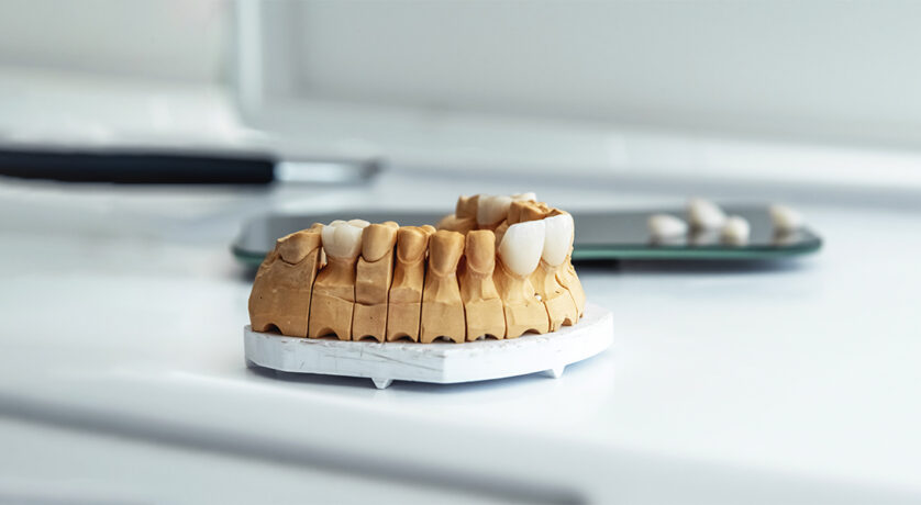 What Are the Differences between Veneers and Lumineers?