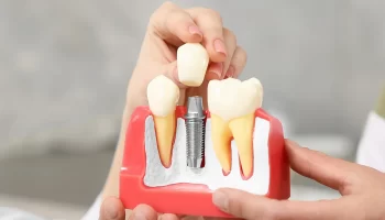 The Longevity of Dental Implants: What to Expect in the Long Run