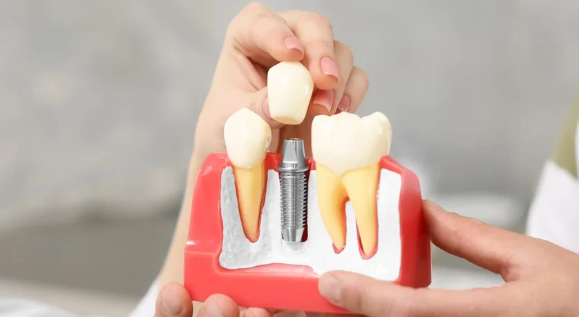 The Longevity of Dental Implants