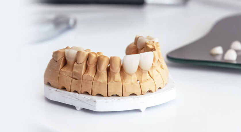 The-Ultimate-Guide-to-Lumineers--Transforming-Your-Smile