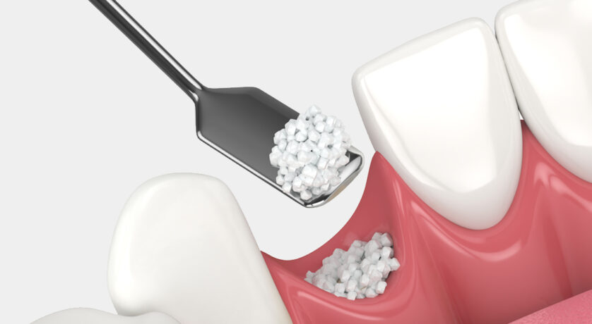 5 Cosmetic Flaws We Can Treat With Dental Bonding