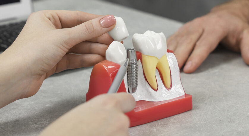 How Dental Implants Can Boost Your Dental Health