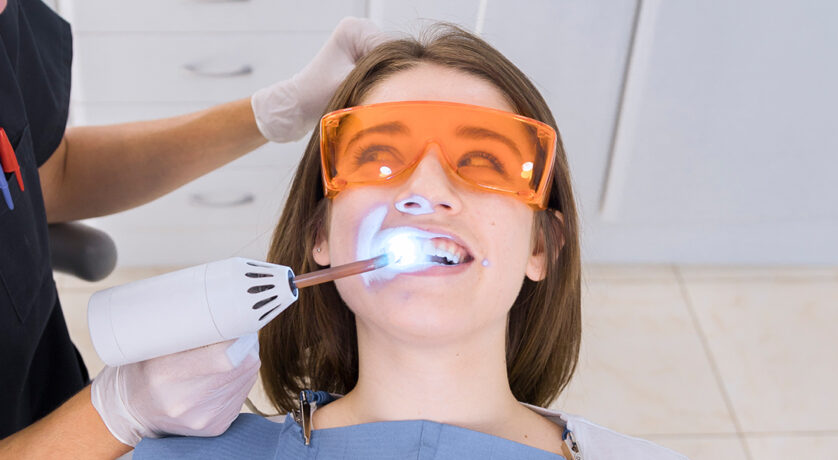 How Do I Care for My Teeth After Dental Bonding?