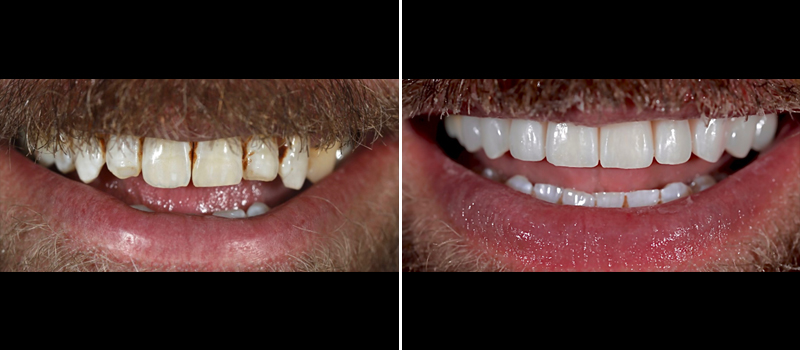 beforeafter