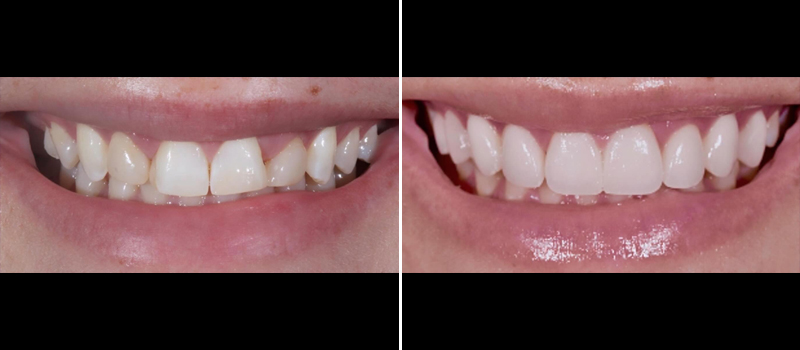beforeafter