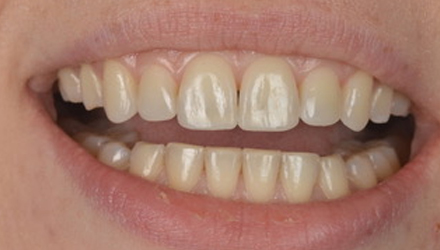 Before-before-after