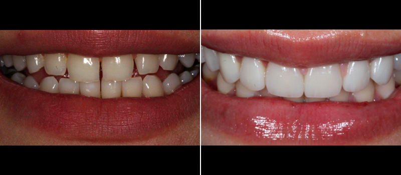 Porcelain Veneers 