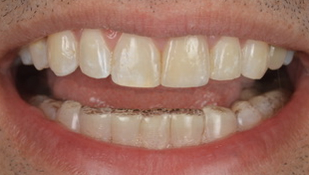 After-before-after