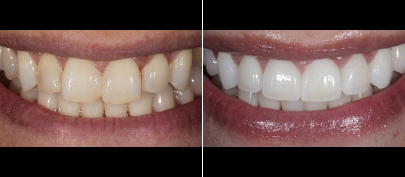 Porcelain Veneers 3