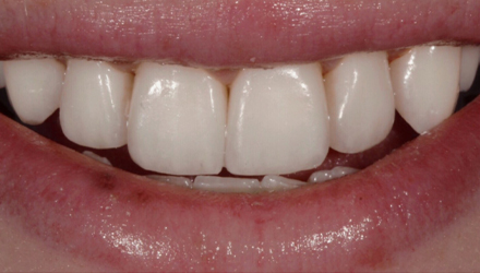 After-before-after