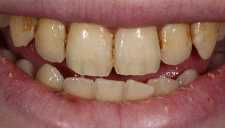 Before-before-after