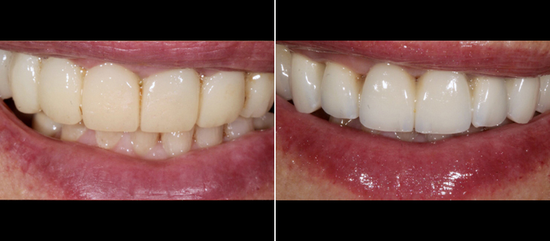 Full arch implants