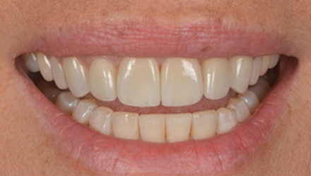 After-before-after