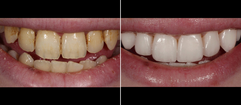 Porcelain Crowns