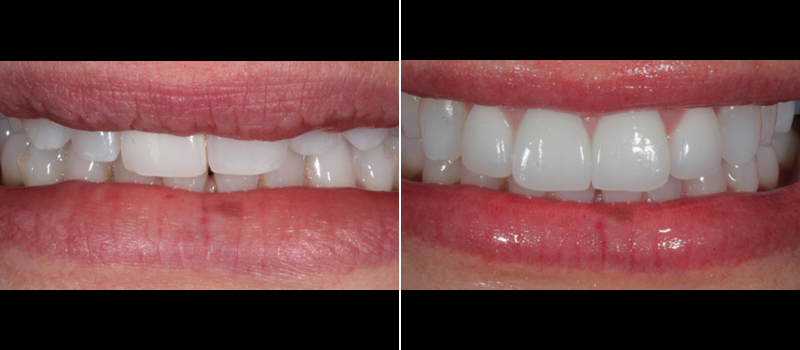 Porcelain Crowns 2