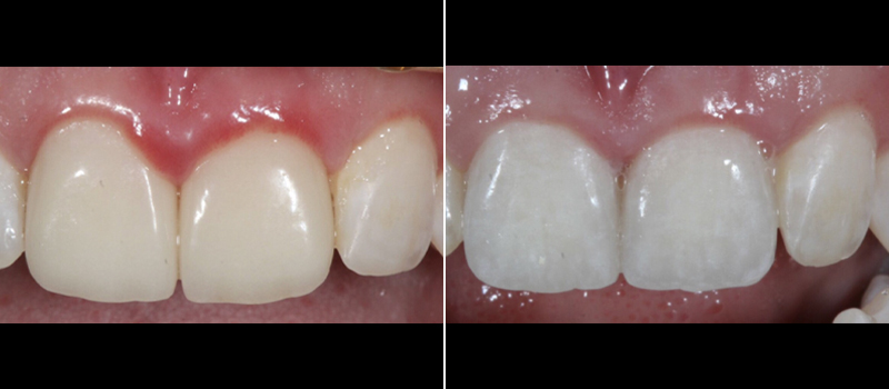 Veneers