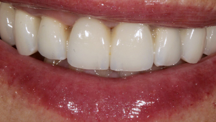 After-before-after
