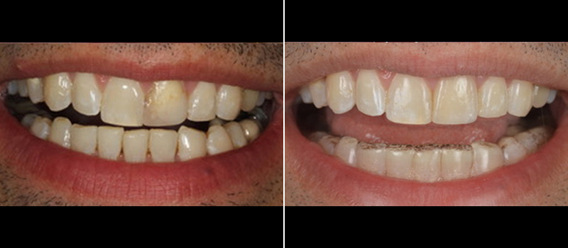 Veneers 2