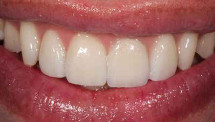 After-before-after