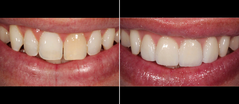 Porcelain Veneers 2