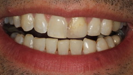 Before-before-after