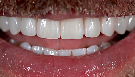 After-before-after