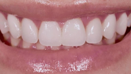 After-before-after