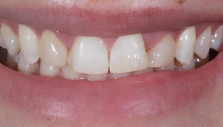 Before-before-after