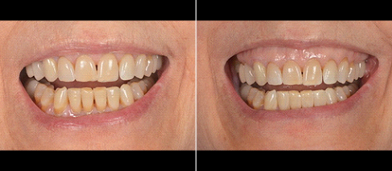 beforeafter