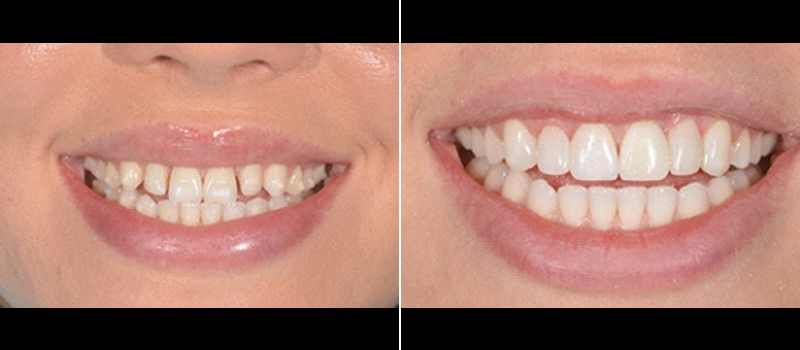 beforeafter