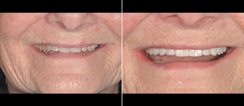 beforeafter