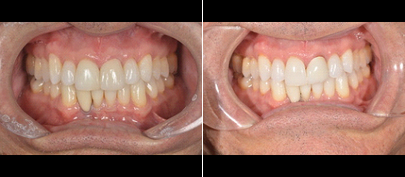 beforeafter