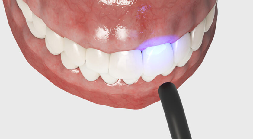 Everything You Need to Know About Dental Bonding