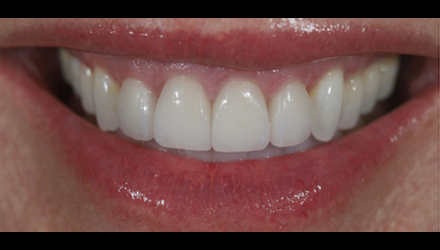 After-before-after