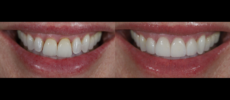 beforeafter