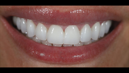 After-before-after