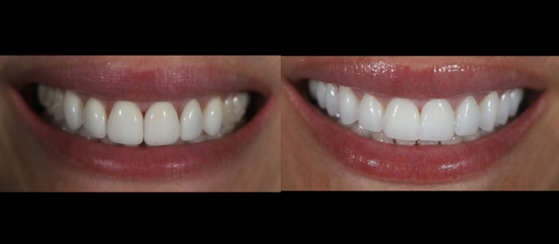 beforeafter