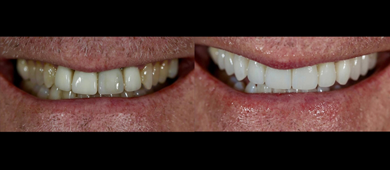 beforeafter