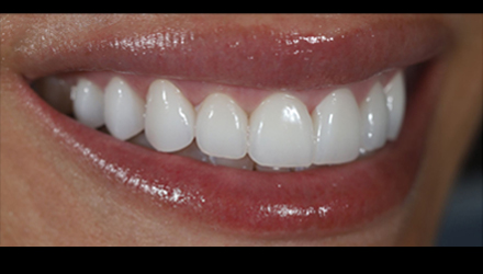 After-before-after