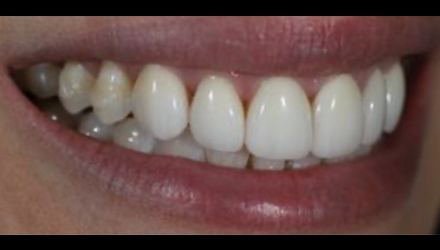 Before-before-after