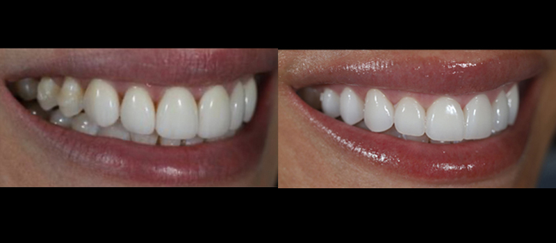 beforeafter