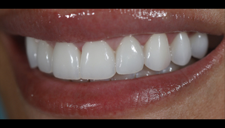 After-before-after