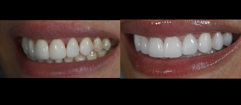 beforeafter