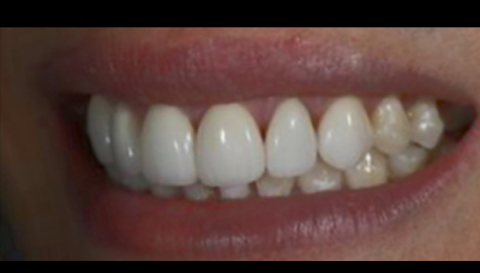 Before-before-after