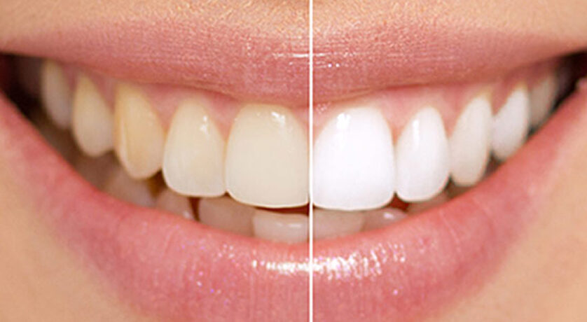 Porcelain Veneers