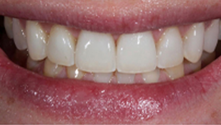 After-before-after